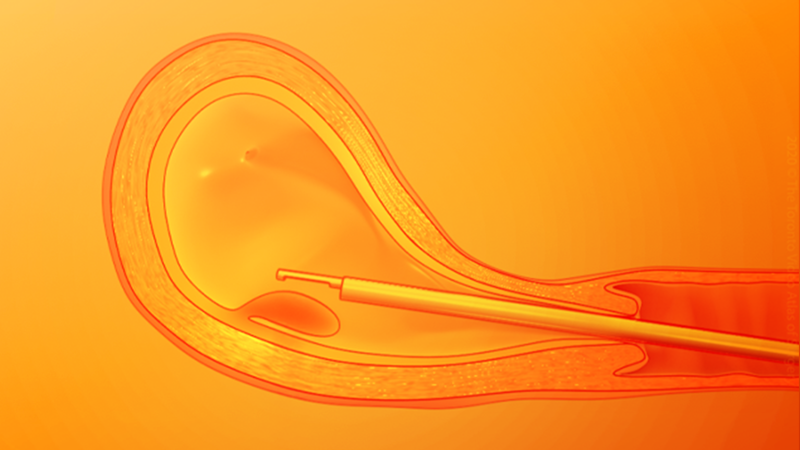 Title: Hysteroscopy Before IVF: What It Is and Why It Matters | Pluro